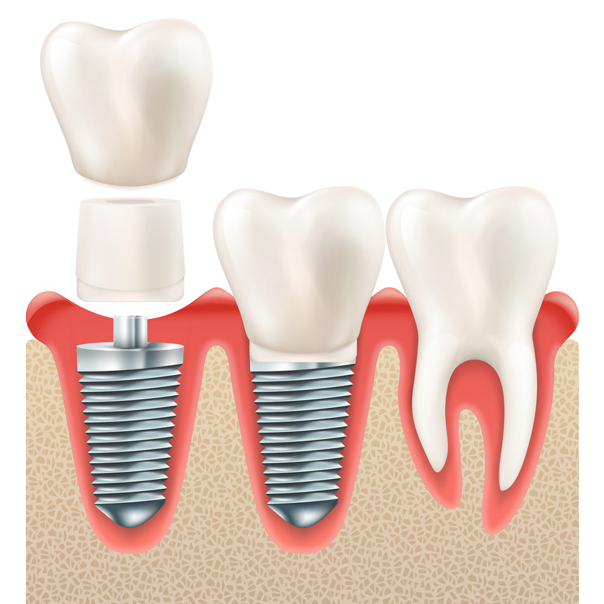 Dental Implant in Indira Nagar Nashik