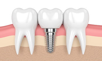 Best dental implant clinic in Govind Nagar, Nashik